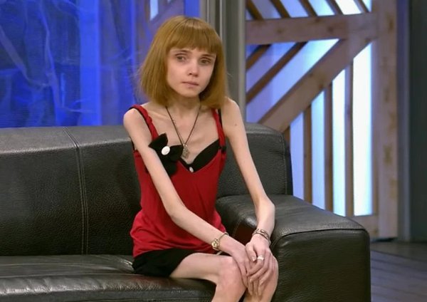 Кристина корягина из барнаула как выглядит сейчас Весившая 17 килограммов Кристина Корягина победила анорексию, резкое похудение Д