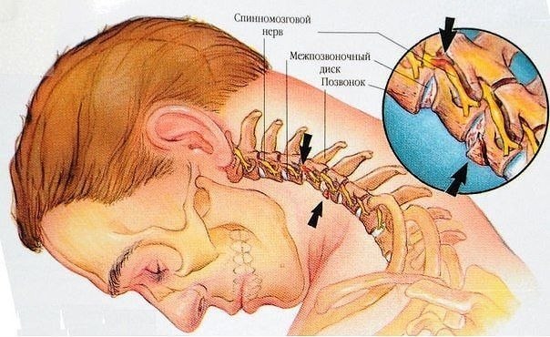 Boceмь yпpaжнeний пpoтив шeйнoгo ocтeoxoндpoзa.Пepвыe пpoявлeния шeйнoгo ocтeoxoндpoзa — бoли в ...