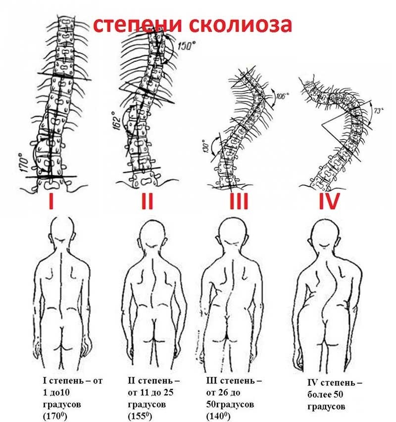 Сколиоз у детей картинки