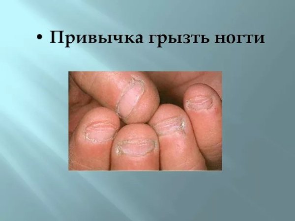 Вредная привычка грызть ногти и как с ней бороться.Обкусывание ногтей, ковыряние заусенцев и кожи ...