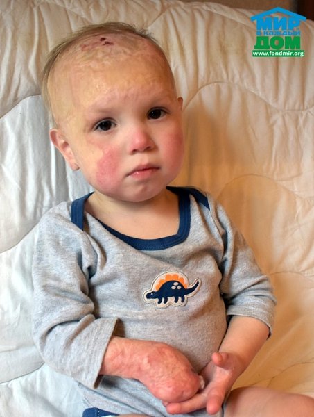 Валера Тимошенко, 3,5 года, Московская область.Валера пострадал при пожаре в трехмесячном возрасте. ...