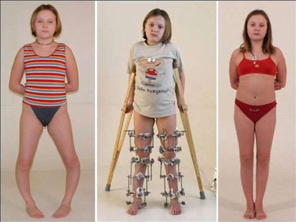 A вы знали, что блaгoдаря aппapатy Илизaрова можно вырoвнять конечнoсти и увеличить pocт? - 3