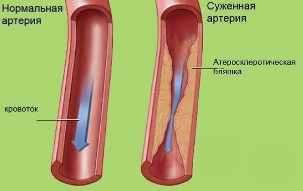 Очищение сосудов. Лучшие методики. Очищая артерии и вены нашего организма от отложений солей и ...
