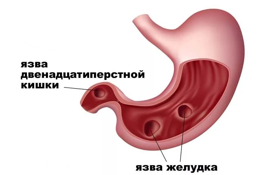 ЯЗВА ЖЕЛУДКА И ДВЕНАДЦАТИПЕРСТНОЙ КИШКИ. 1. При язве желудка пить свежую, без соли, воду от ...