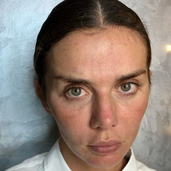 Синяки под глазами: причины и последствия ПульсПлюс Дзен