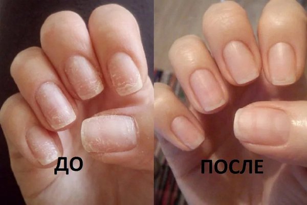 Как восстановить пластину после ношения гель-лака.Гель-лак вредит ногтямТак ли этоОднозначного ...
