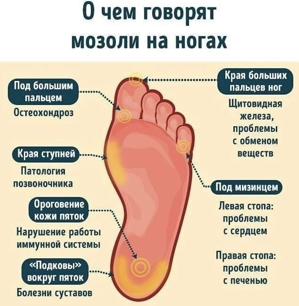 Сухой мозоль на стопе лечение фото