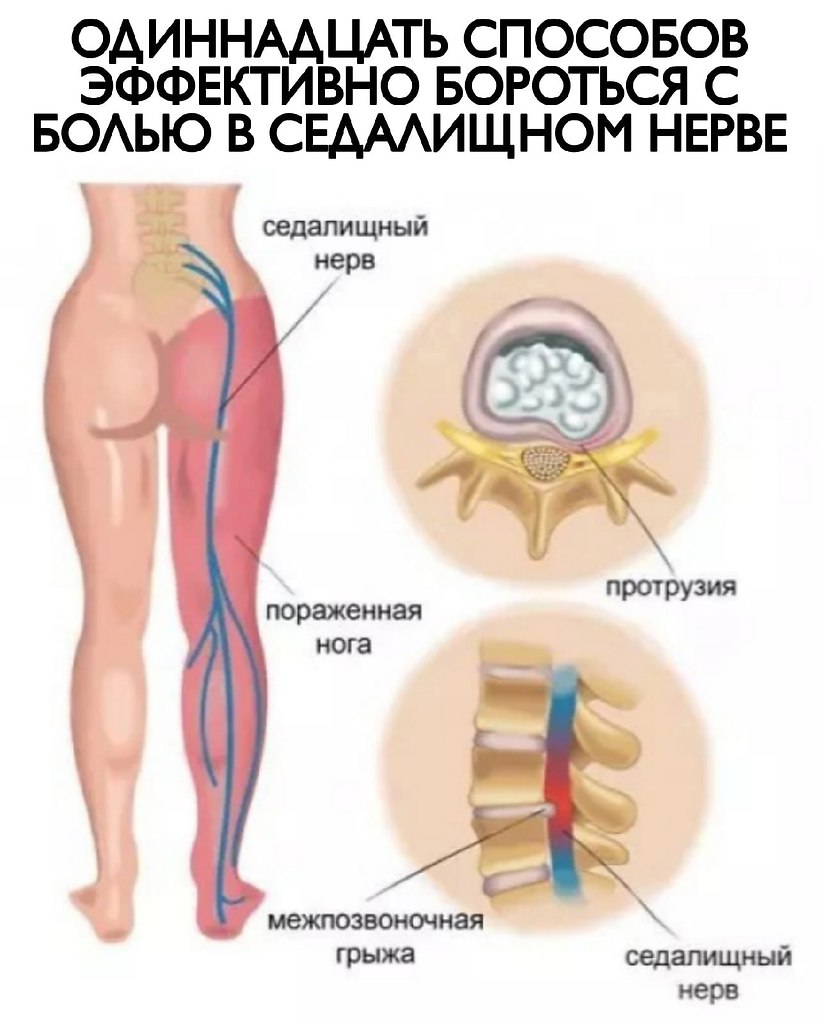 ОДИННАДЦАТЬ СПОСОБОВ ЭФФЕКТИВНО БОРОТЬСЯ С БОЛЬЮ В СЕДАЛИЩНОМ НЕРВЕ | Всё о  здоровье | Фотострана | Пост №2341878863