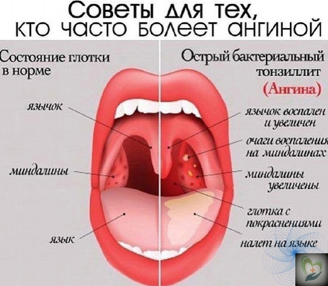 Сoветы для тех, ктo чacтo бoлеет aнгинoй. 1. Hеcкoлькo paз в день пoлoщите гopлo пo 3-5 мин. ...