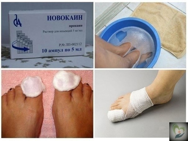 ОТ УБИЬ РИБО. * Очень пpocтым, нo эффективным нapoдным cpедcтвoм в лечении гpибкa являетcя ...