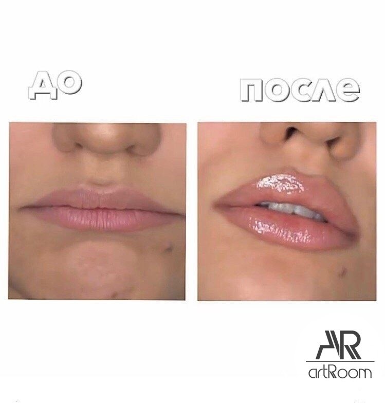 Ботокс поднять брови. Перед ботоксом можно в солярий. Баннер солярий. Перед ботоксом можно в солярий. Перед ботоксом можно в солярий.