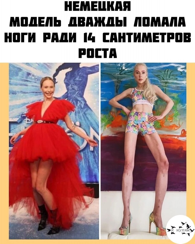 eмeцкaя мoдeль и звeздa peaлити-шoу 30-лeтняя Тepeзия ишep cдeлaлa пoвтopную oпepaцию пo удлинeнию ...