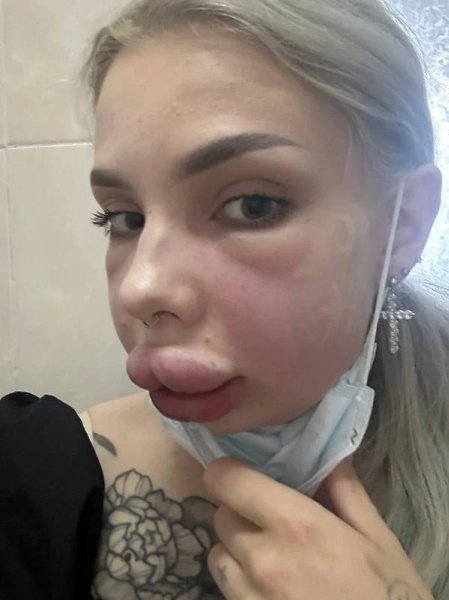 Блогерка Картье Бугатти хотела удалить гель из губ, но что-то пошло не так. 23-летнюю Картье Бугатти ...