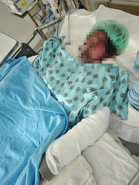 Девушка-айтишница из Таиланда потеряла зрение, половину кожи и впала в кому из-за лекарства ... - 3