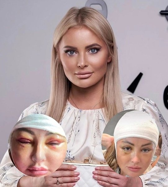 «На 20 лет моложе.» Дана Борисова показала, как выглядит её лицо после голливудской подтяжки. ...