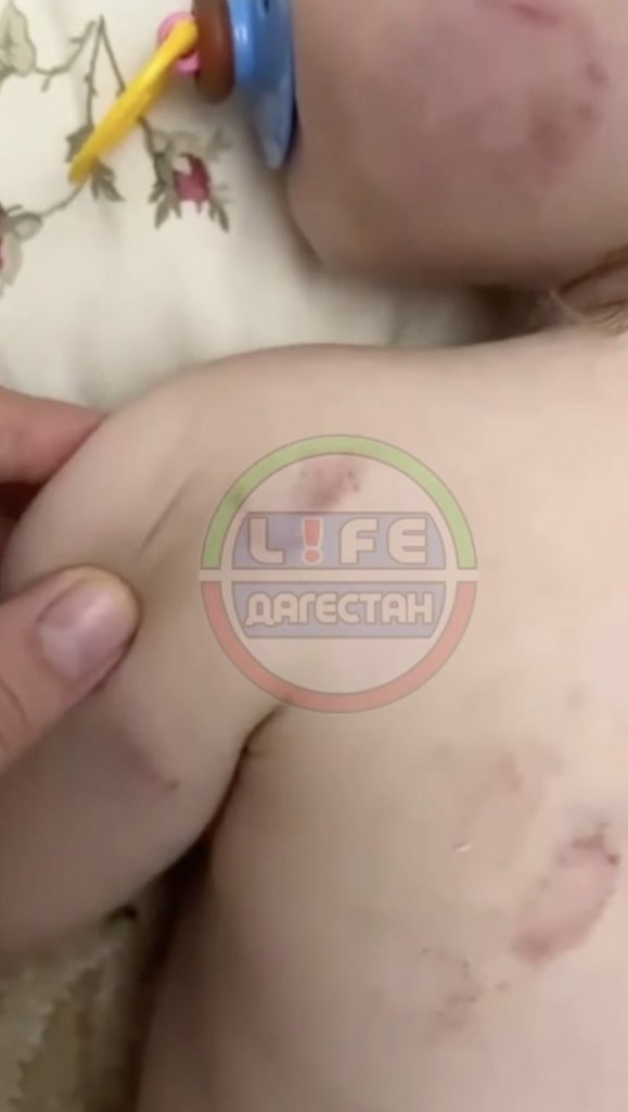 Маленькая девочка получила множественные укусы в детском саду в селе Новый-Чиркей в Кизилюртовском ... - 2