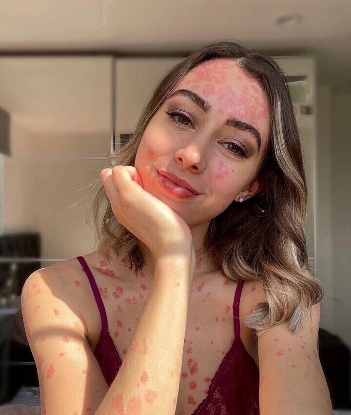 ПОЧЕМУ Я НЕ ЛЕЧУ СВОЙ ПСОРИАЗ? Клэр Элизабет живёт с псориазом и делится своей историей борьбы с ... - 3