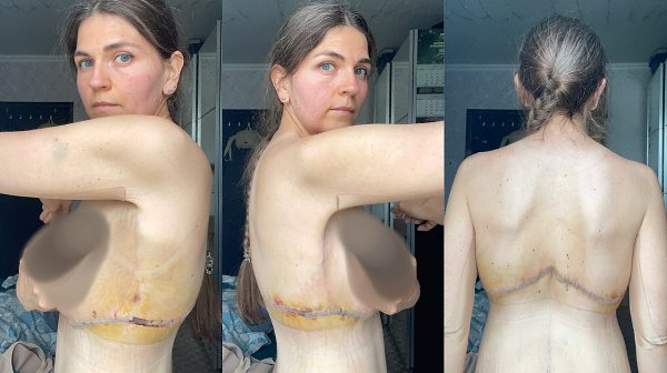 Удаление кожи с ног и верхней части спины после похудения на 77 кг - 4