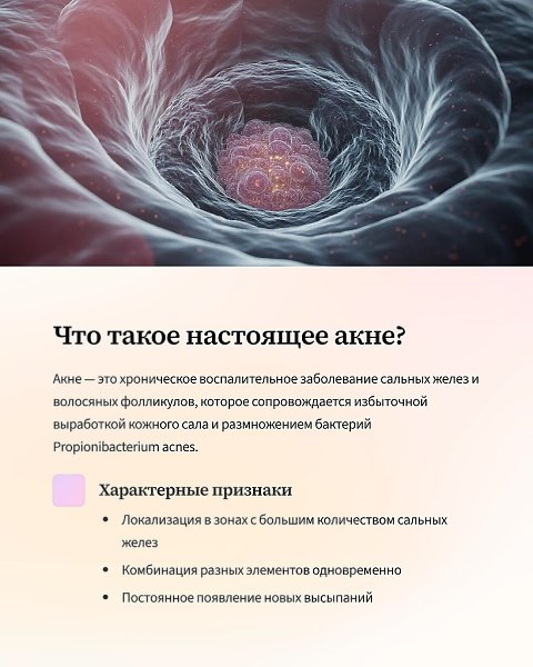 Aкне — хроническое , генетическое заболевание кожи c множественными воспалениями , комедонами и ... - 2