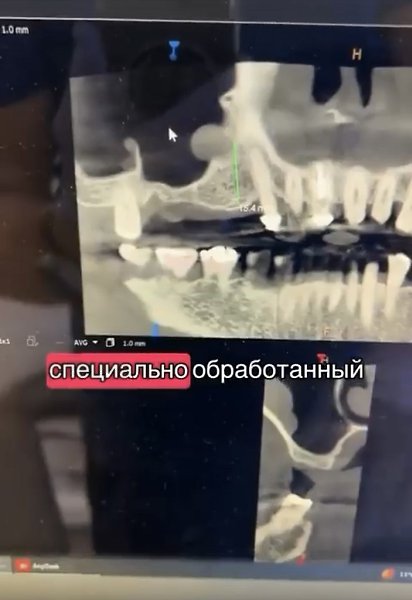 Позаботьтесь о сохранности ваших зубов мудрости. - 2