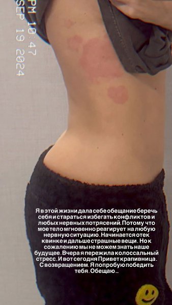 Анна Седокова рассказала о причинах развода с мужем и показала сыпь на теле от стресса.Недавно ... - 2