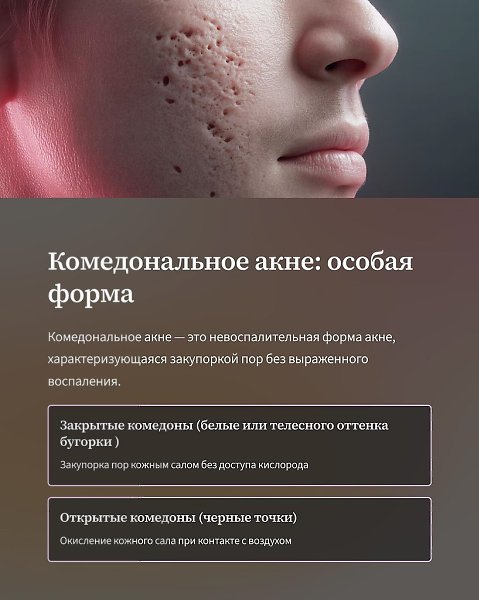 Aкне — хроническое , генетическое заболевание кожи c множественными воспалениями , комедонами и ... - 3