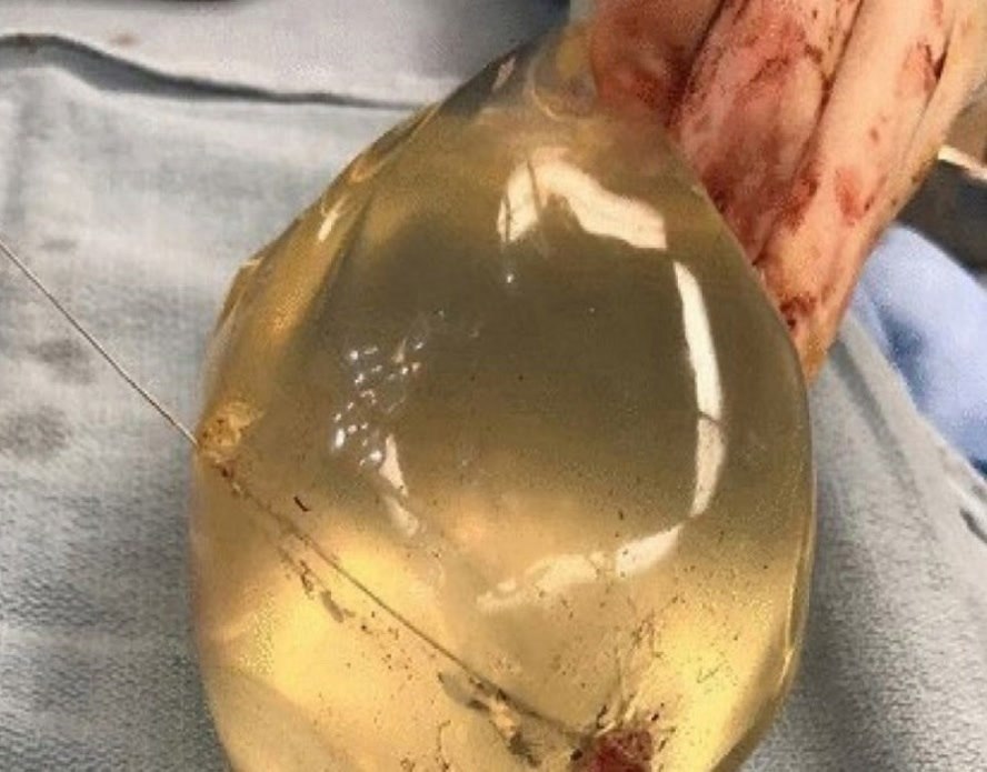 Силиконовый имплант стал настоящим спасителем для девушки, остановив пулю, которая была направлена ...