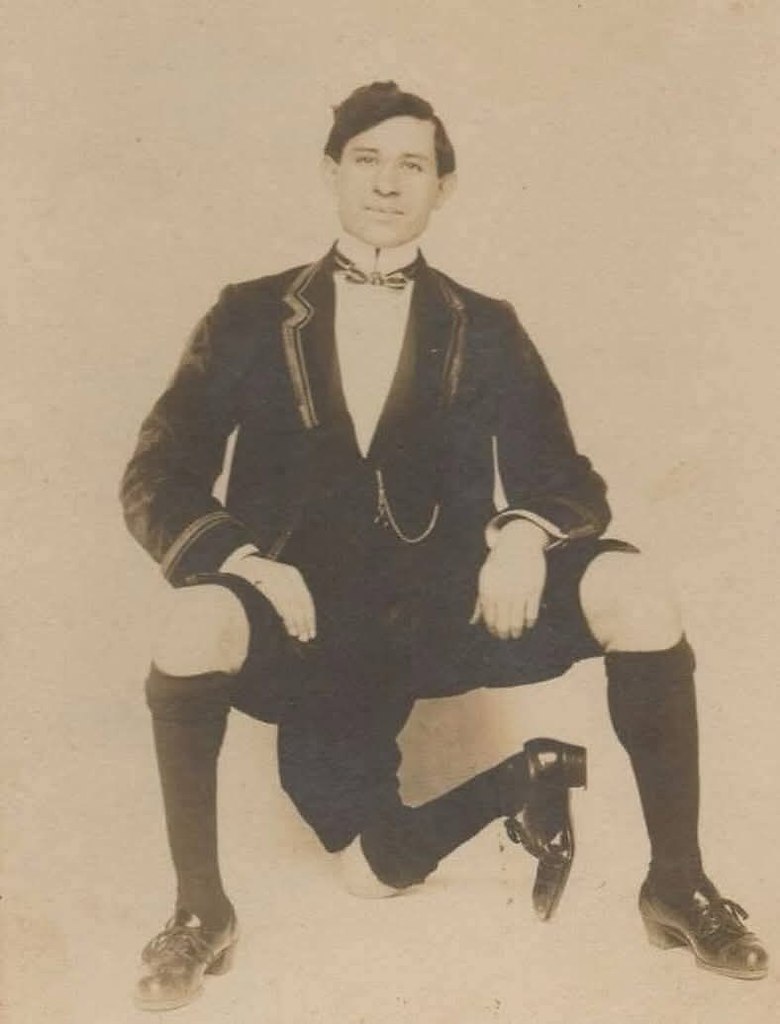 :) Американец итальянского происхождения Фрэнк Лентини (1889 - 1966) родился с тремя ногами разной ...