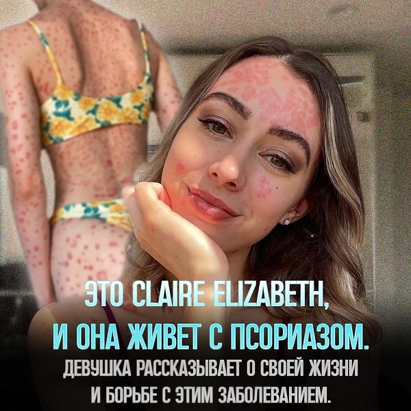 Представляем Клер Элизабет, чья жизнь омрачена кожным недугом – псориазом. Она делится личным опытом ...