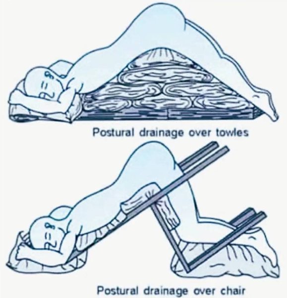 :) В 1976 году во Вьетнаме вспыхнула тяжёлая эпидемия гриппа, которая с особой силой поразила дома ...