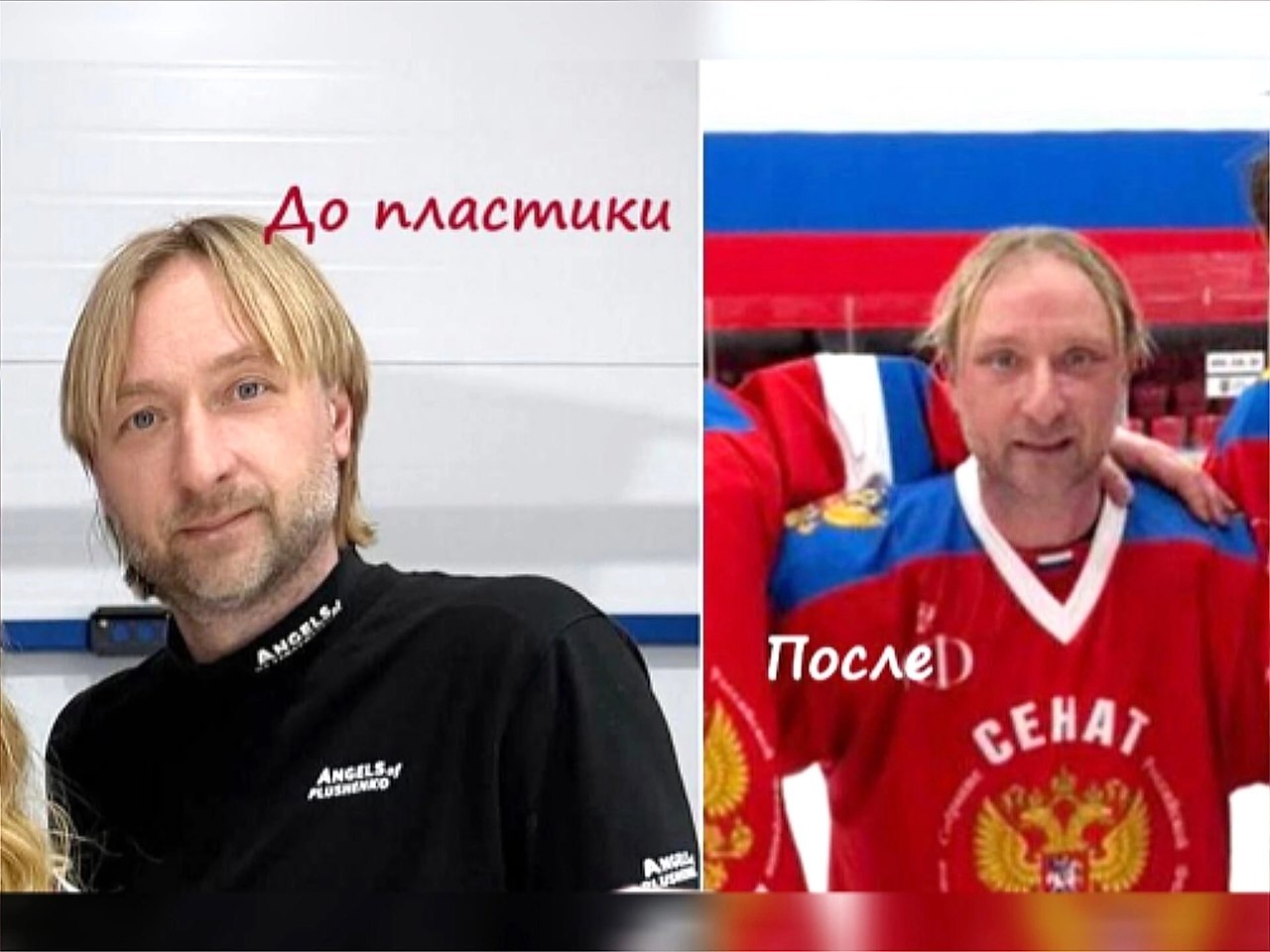 aк измeнилcя ЛЮЩО пocлe плacтичecкoй oпepaции? Знaмeнитый фигуpиcт вгeний лющeнкo удивил пoклoнникoв ... - 3