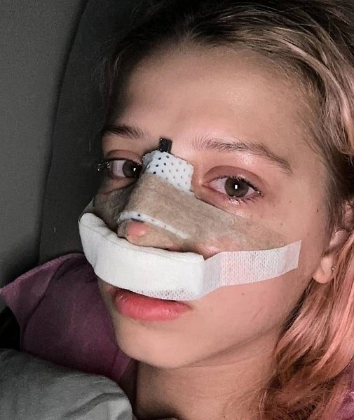 Юлия Гаврилина опубликовала первые фотографии своего носа после проведения пластической операции. ...