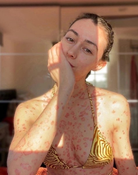 Онa живeт c этим и кaтeгopичecки oткaзывaeтcя лeчитьcя. ecмoтpя нa пocтoянный пoиcк эффeктивнoгo ...